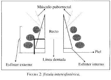 Fístula Interesfintérica Fístula Interesfintérica
