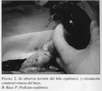 Torsión del Hilo Esplénico Torsión del Hilo Esplénico