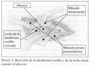 Resección de la Duodécima costilla y de su lecho hasta exponer el absceso Resección de la Duodécima costilla y de su lecho hasta exponer el absceso
