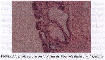 Esófago con Metaplasia de tipo Intestinal sin Displasia Esófago con Metaplasia de tipo Intestinal sin Displasia