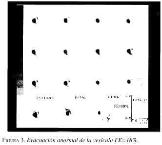 Evacuación Anormal de la Vesícula