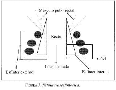 Fístula Trasesfintérica Fístula Trasesfintérica
