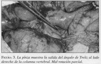 Salida del ángulo de Treitz Salida del ángulo de Treitz