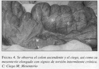 Colon Ascendente y el Ciego Colon Ascendente y el Ciego