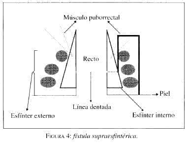 Fístula Supraesfintérica Fístula Supraesfintérica