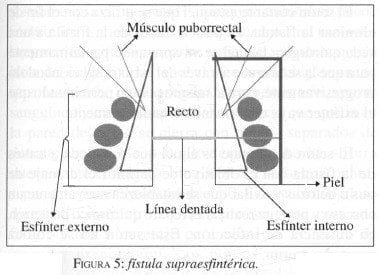 Fístula Supraesfintérica Fístula Supraesfintérica