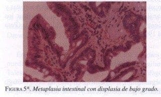 Metaplasia Intestinal con Displasia de bajo grado Metaplasia Intestinal con Displasia de bajo grado