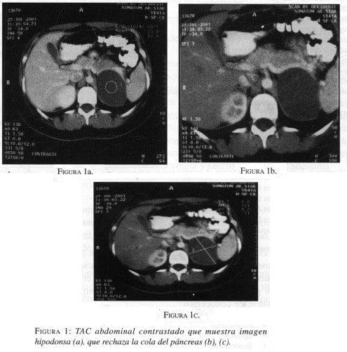 TAC abdominal contrastado