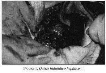 Quiste Hidatídico Hepático