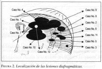 Localización de las Lesiones Diafragmáticas Localización de las Lesiones Diafragmáticas