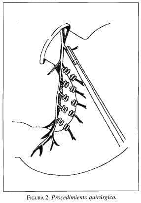 Procedimiento Quirúrgico Procedimiento Quirúrgico