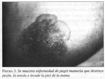 Enfermedad de Paget Mamaria Enfermedad de Paget Mamaria
