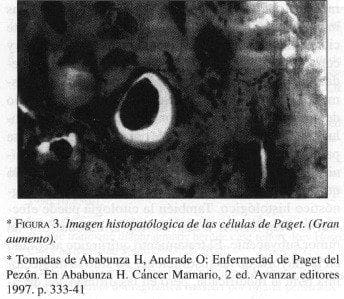 Imagen Histopatólogica de las células de Paget. (Gran aumento) Imagen Histopatólogica de las células de Paget. (Gran aumento)