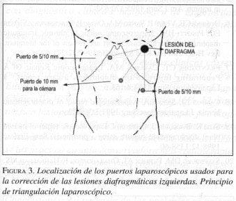 Localización de los Puertos Laparoscópicos Localización de los Puertos Laparoscópicos