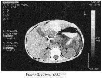 Seudotumor Inflamatorio de Hígado, Primer TAC Seudotumor Inflamatorio de Hígado, Primer TAC