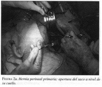 Hernia Perineal Primaria: Apertura del Saco a nivel de su cuello Hernia Perineal Primaria: Apertura del Saco a nivel de su cuello