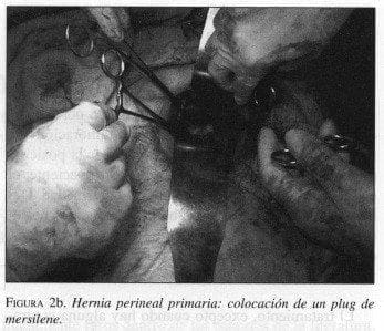 Hernia Perineal Primaria: colocación de un Plug de Mersilene Hernia Perineal Primaria: colocación de un Plug de Mersilene