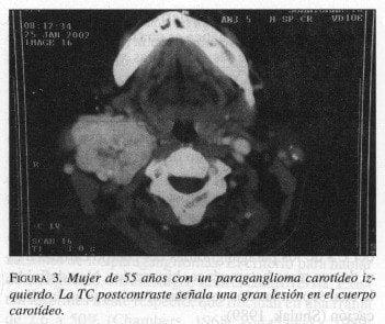 Mujer de 55 años con un Paraganglioma Carotídeo izquierdo Mujer de 55 años con un Paraganglioma Carotídeo izquierdo