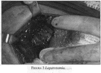Seudotumor Inflamatorio de Hígado, Laparotomía Seudotumor Inflamatorio de Hígado, Laparotomía