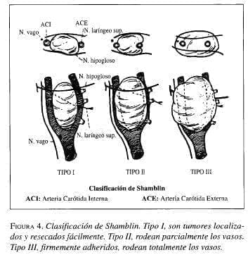 Clasificación de Shamblin Clasificación de Shamblin