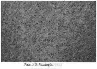Seudotumor Inflamatorio de Hígado, Patología Seudotumor Inflamatorio de Hígado, Patología