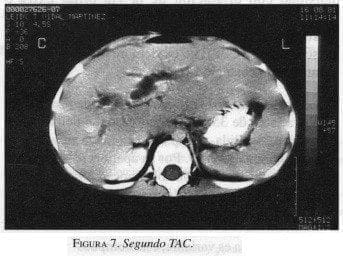 Seudotumor Inflamatorio de Hígado, Segundo TAC Seudotumor Inflamatorio de Hígado, Segundo TAC