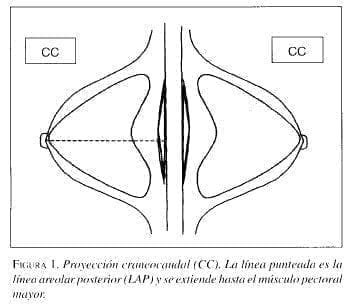 Proyección Craneocaudal