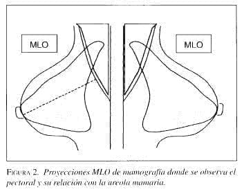 Proyecciones MLO de Mamografía Proyecciones MLO de Mamografía