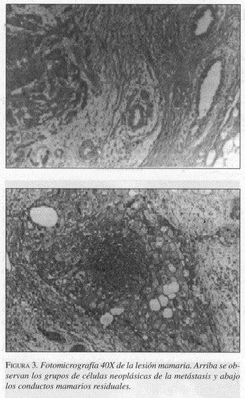 Fotomicrograjía 40X de la Lesión Mamaria Fotomicrograjía 40X de la Lesión Mamaria