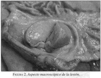 Tumores Gástricos Estromales, Aspecto macroscópico de la lesión Tumores Gástricos Estromales, Aspecto macroscópico de la lesión