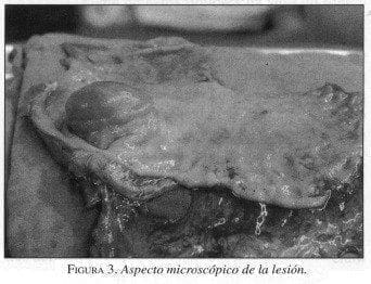 Tumores Gástricos Estromales, Aspecto macroscópico de la lesión Tumores Gástricos Estromales, Aspecto macroscópico de la lesión