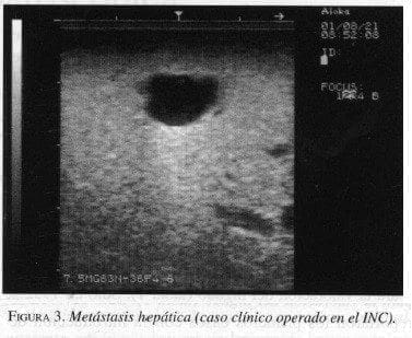 Metástasis Hepática