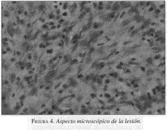 Tumores Gástricos Estromales, Aspecto macroscópico de la lesión Tumores Gástricos Estromales, Aspecto macroscópico de la lesión