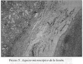 Tumores Gástricos Estromales, Aspecto macroscópico de la lesión Tumores Gástricos Estromales, Aspecto macroscópico de la lesión