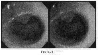 Ectasia Vascular Antral