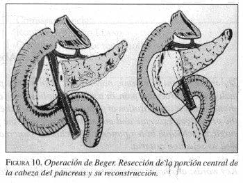 Operación de Beger Operación de Beger