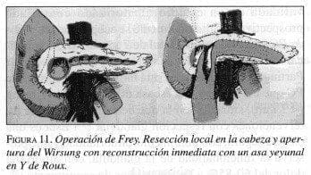 Operación de Frey Operación de Frey