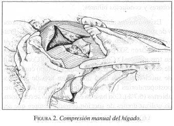 Compresión manual del Hígado