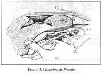 Maniobra de Pringle