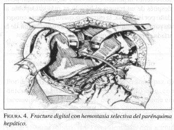 Fractura digital con Hemostasia selectiva del Parénquima Hepático