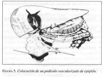 Colocación de un Pedículo Vascularizado de Epiplón