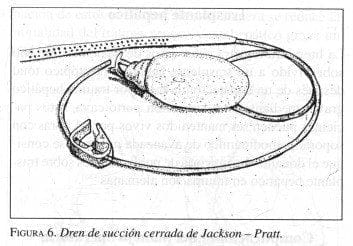 Dren de succión cerrada de Jackson - Pratt.