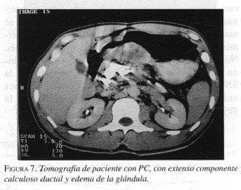 Tomografía de paciente con Pancreatitis Crónica Tomografía de paciente con Pancreatitis Crónica