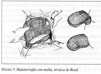 Hepatorrafía con malla, técnica de Reed