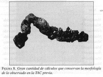 Gran cantidad de cálculos, Pancreatitis Crónica Gran cantidad de cálculos, Pancreatitis Crónica