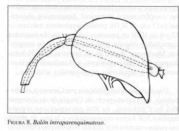 Balón Intraparenquimatoso