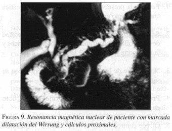 Dilatación del Wirsung y Cálculos proximales Dilatación del Wirsung y Cálculos proximales