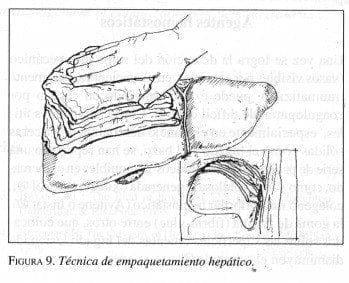 Técnica de Empaquetamiento Hepático