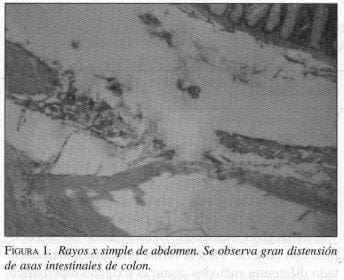 Gran distensión de Asas Intestinales de Colon