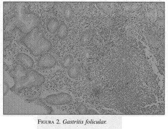 Gastritis Folicular Gastritis Folicular